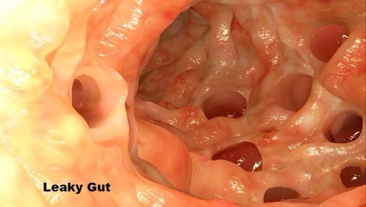 Leaky gut illustration