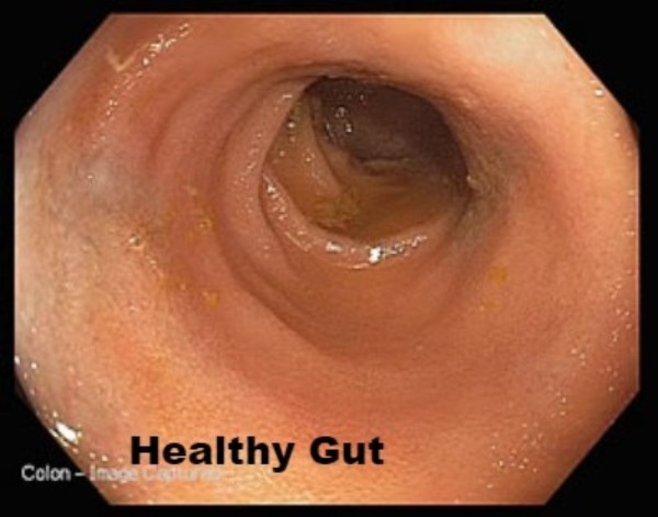Healthy gut colon